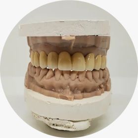 Clip on Veneers