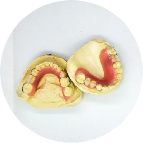 Stayplate (Number Of Missing Teeth: 3 to 7 Missing Teeth)